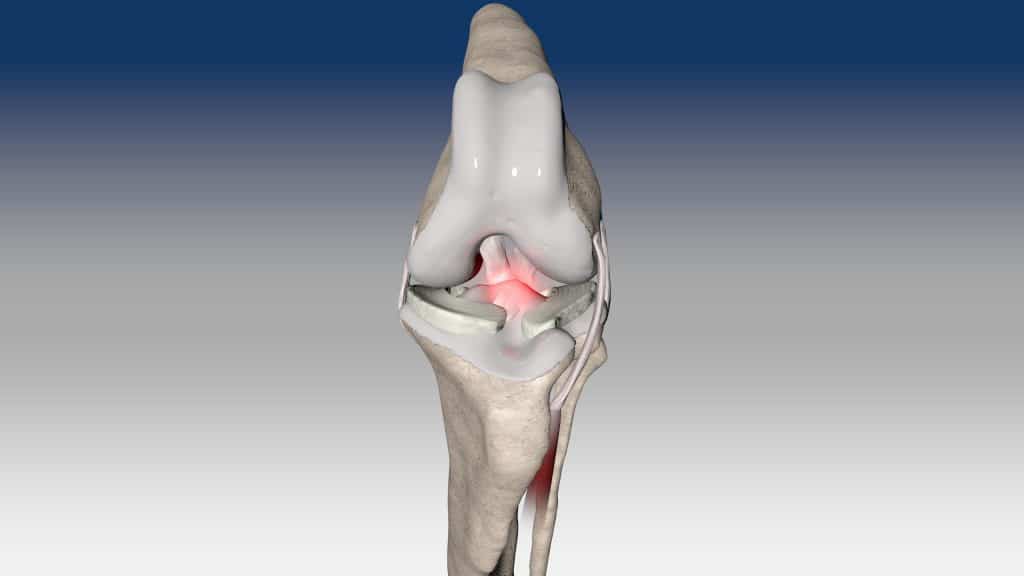 Extra-articular stabilization of cranial cruciate ligament