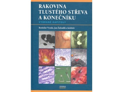 Rakovina tlustého střeva a konečníku