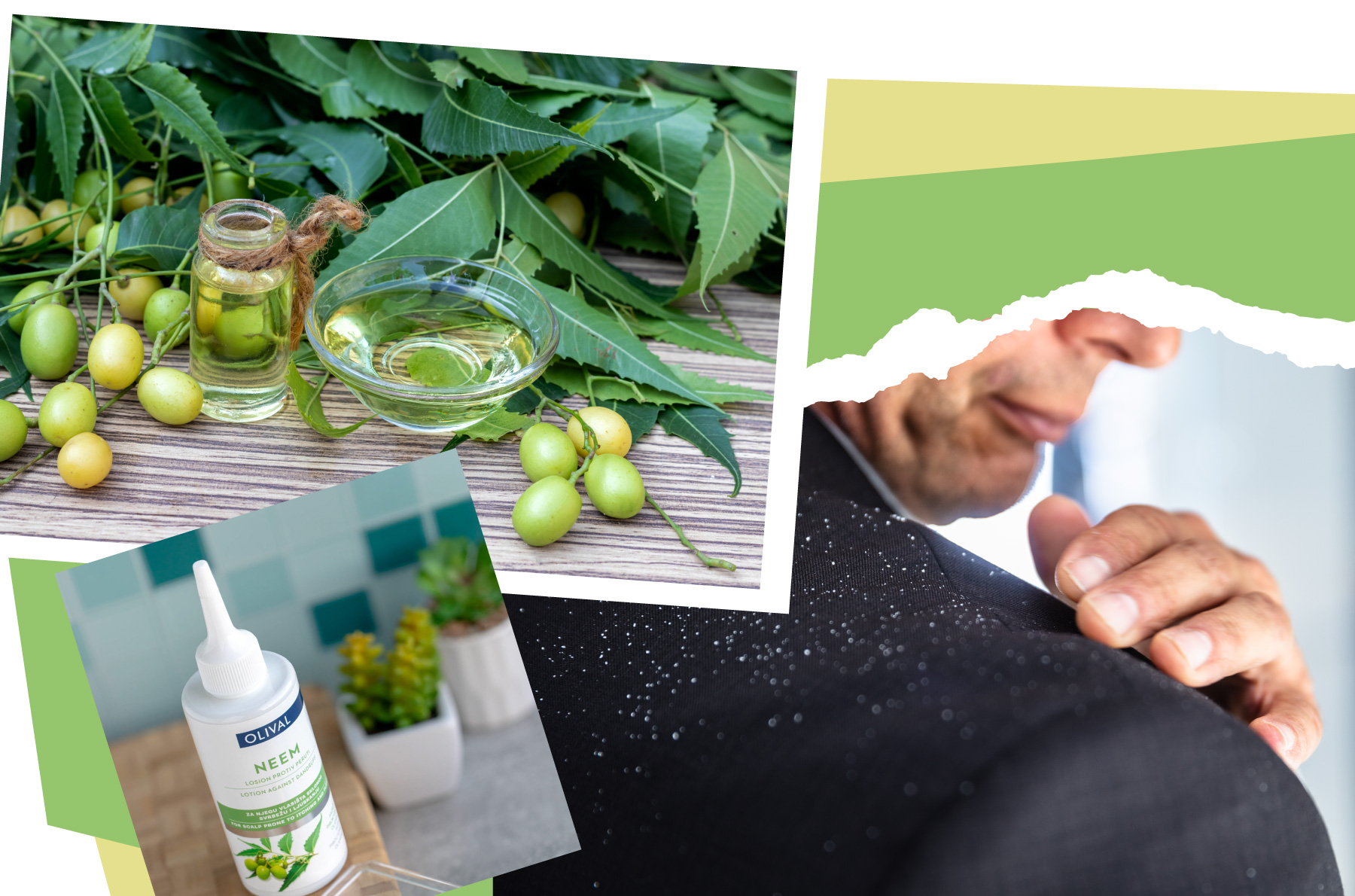 Ako sa zbaviť lupín a olupujúcej sa pokožky hlavy