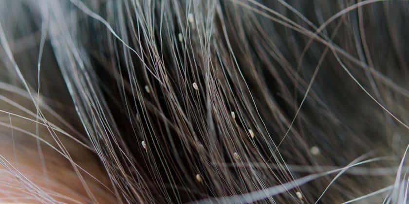 Pedikulóza: Co by měli rodiče vědět o zavšivení u dětí