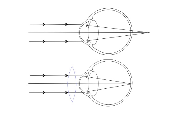 Hypermetropie - dalekozrakost