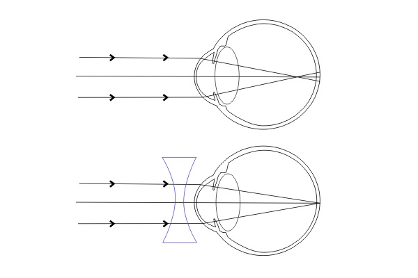 Myopie - krátkozrakost