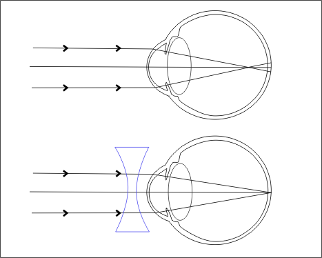 Myopia