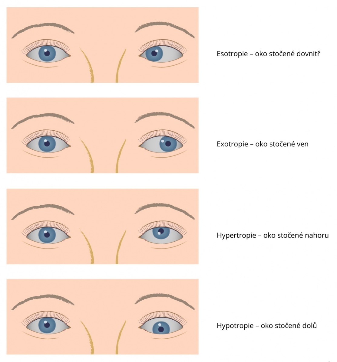 strabismus-silhani