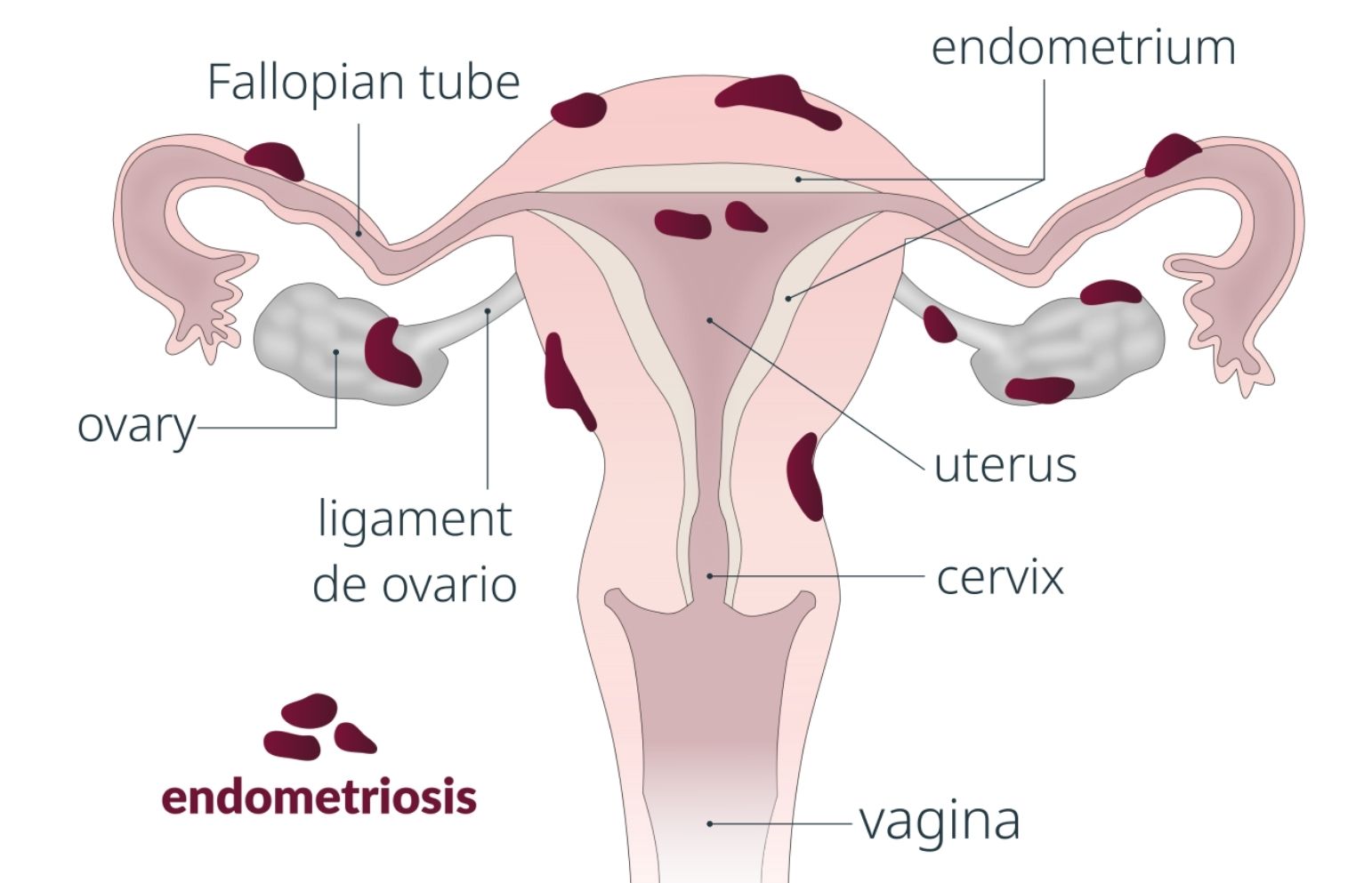 endometrioza_2