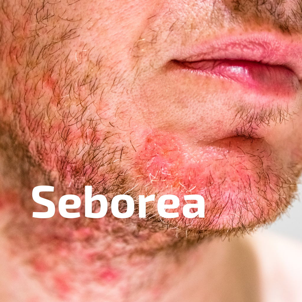 Seborea