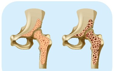 Zdravá kost a kost postižená osteoporózou