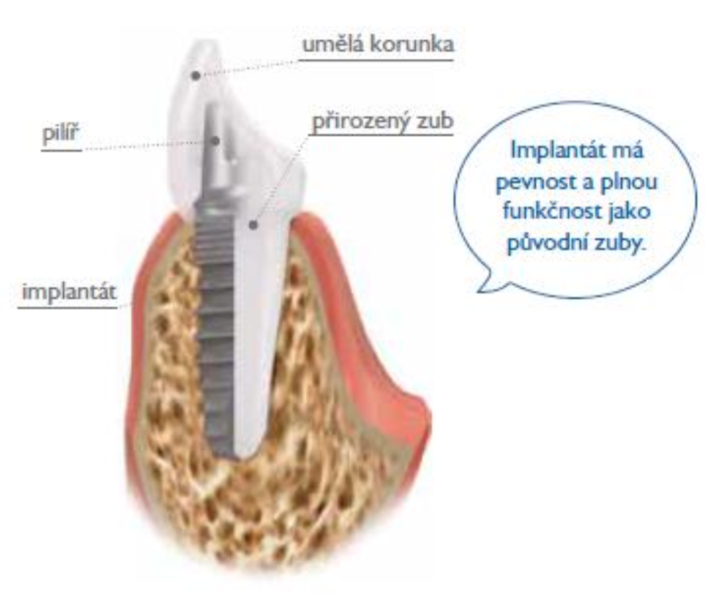 Ilustrační obrázek - zubní implantát