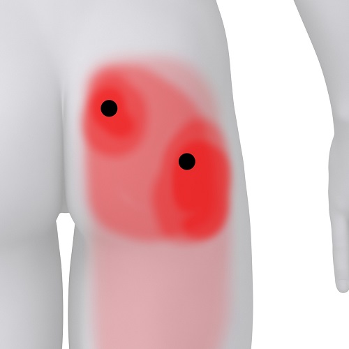 Syndrom M.PIRIFORMIS - co s tím?