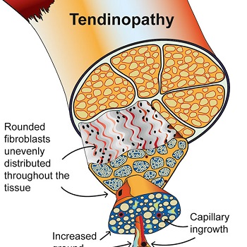 TENDINOPATIE: časté a nepříjemné