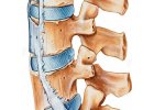 Ankylozující spondylitida (Bechtěrevova nemoc)