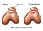 Chondromalacie