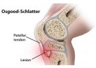 Osgood-Schlatterova choroba