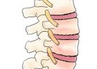 Spondylóza