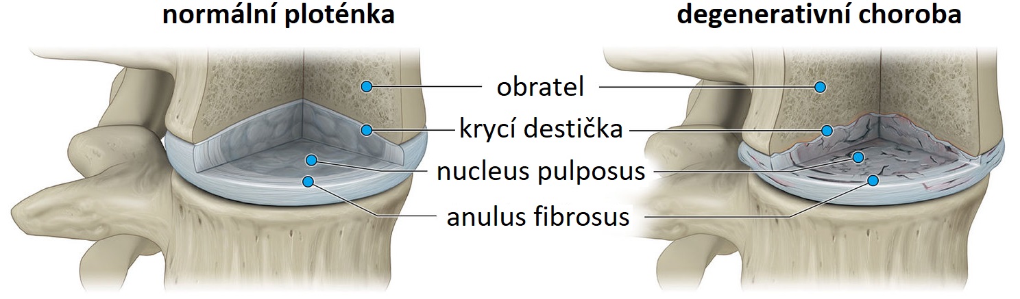 degenerative-disc-disease1500