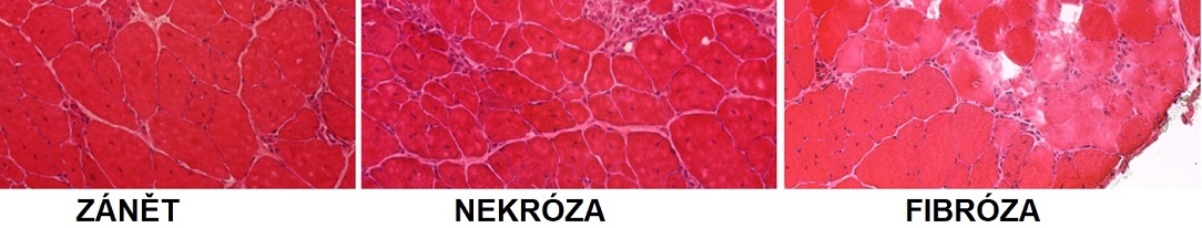 inflamation_necrosis_fibrosis1084x206