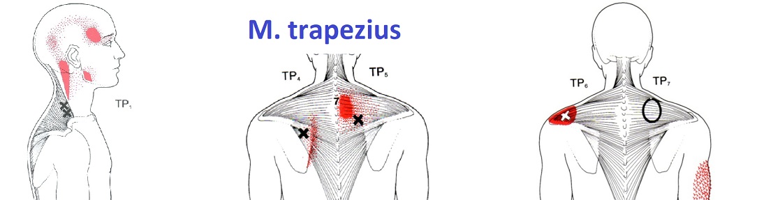 shoulder_TP_trapezius1084x287