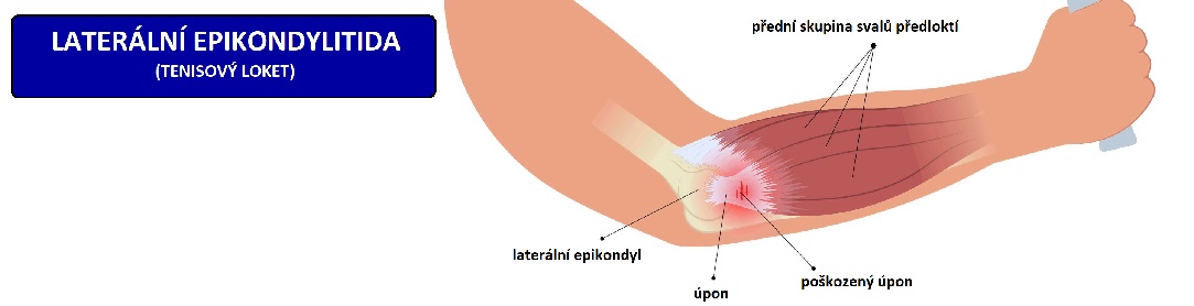 tennis_elbow1083x278