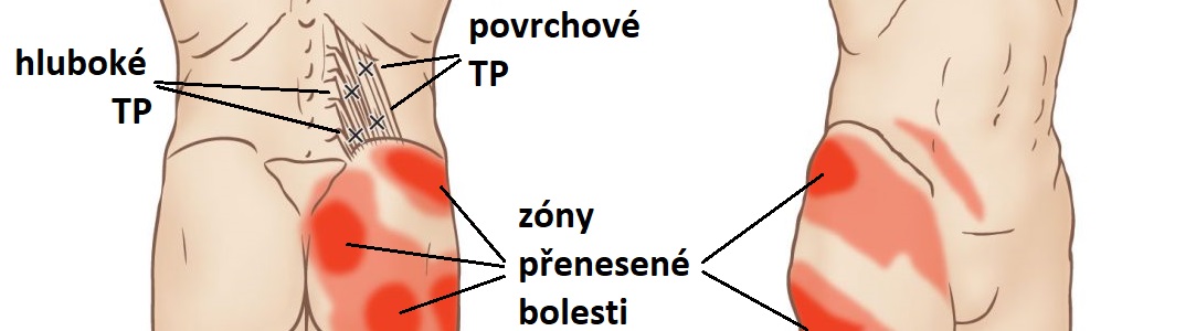 Quadratus-Lumborum-QL-Trigger-PointCZ-1083x300