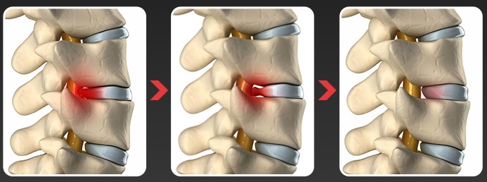 herniated_disc2