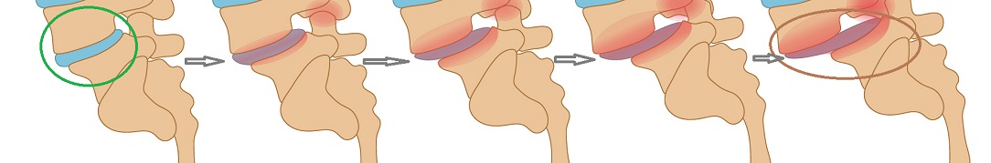 Spondylolisthesis-Stages1084x179