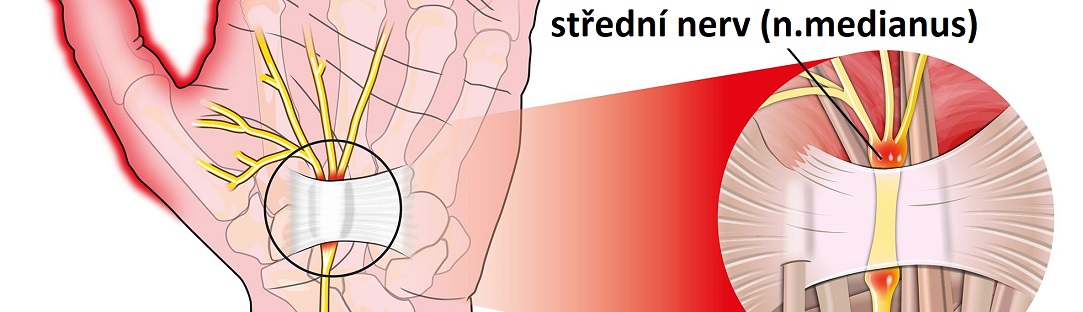 carpal_tunnel_n,med.CZ1083x312