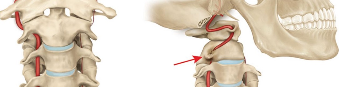 cervical_vertigo_artery_blockage1084x279