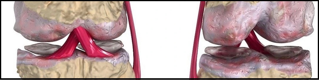 osteoartritis_knee1084x274