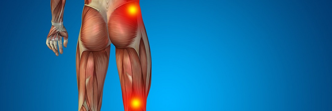 sciatica-wide-1083