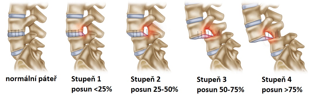 spondylolistesis_gradesCZ1084x328