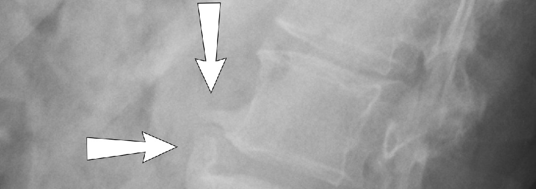 spondylosisL_Xray_1084x383