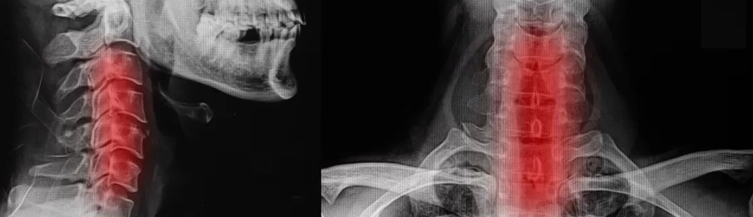 spondylosisXray_1084x313