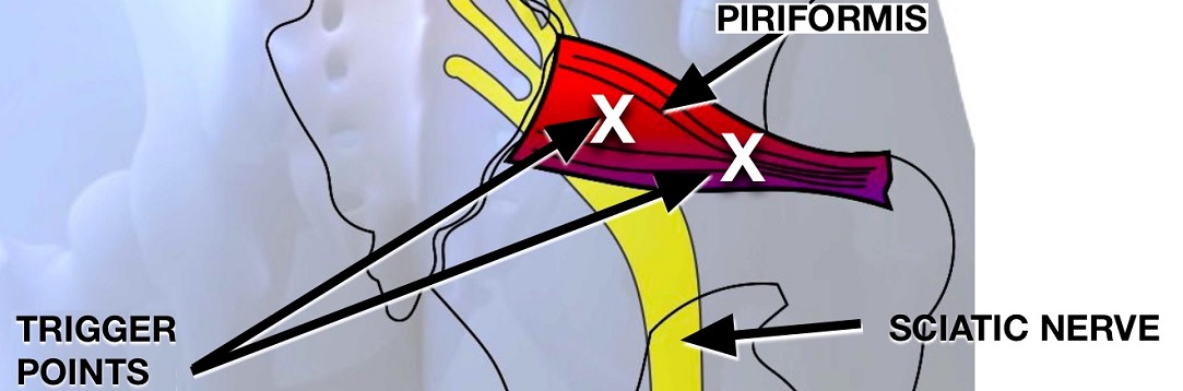 trigger-points_sciatica2_1083x358