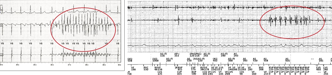 ECG_TENS_artefacts1084x254