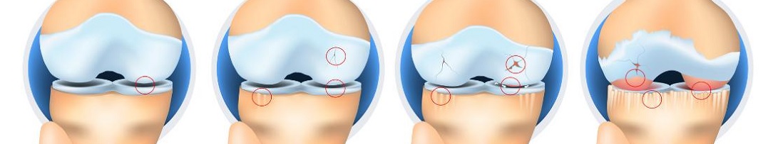 GONARTHROSIS1084x203