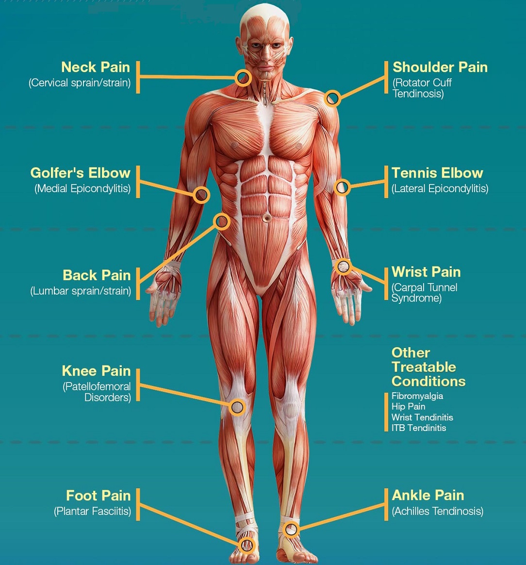 IASTM_treatnent_areas1084x1164