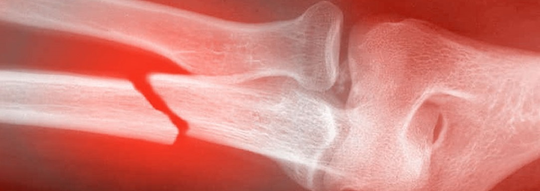 RLTbroken-bones1084x384