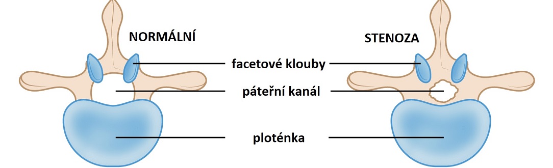 SPINAL_STENOSIS1084x330