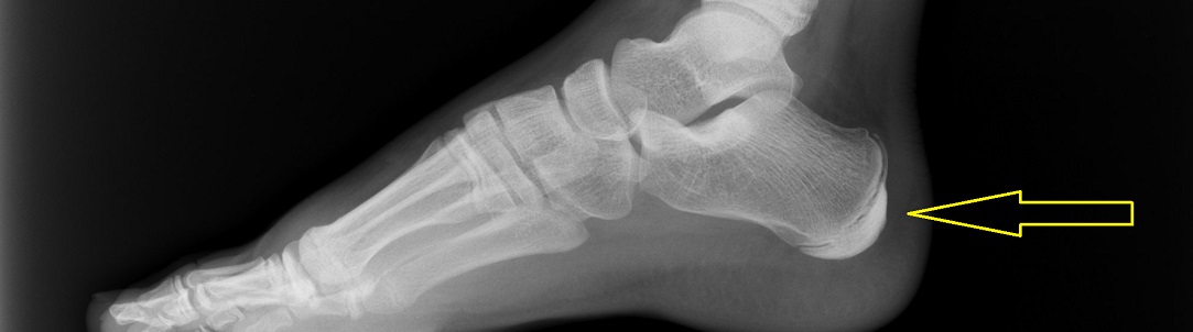 Severova nemoc - bolest paty