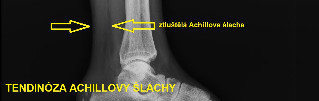 TENDINOSIS_ACHILLES1084X344