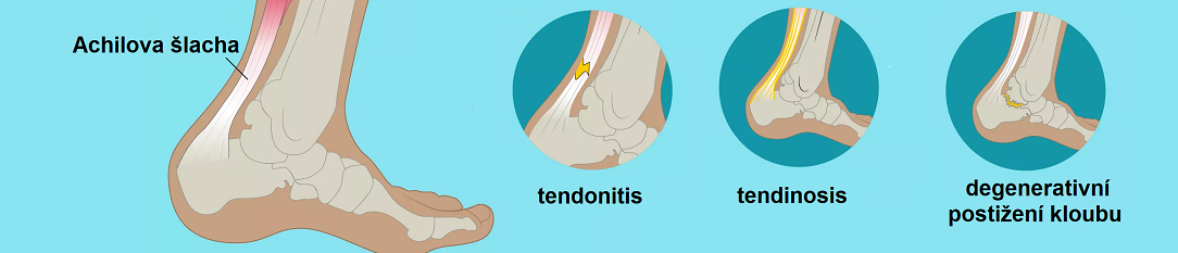 achilles_tendon_disease1084x233