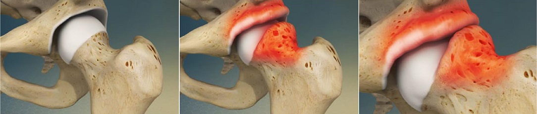 femoroacetabular_sy3_1084x232