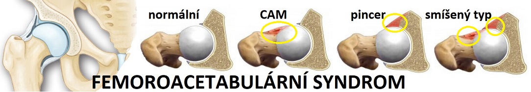 femoroacetabular_syCZ1084x189