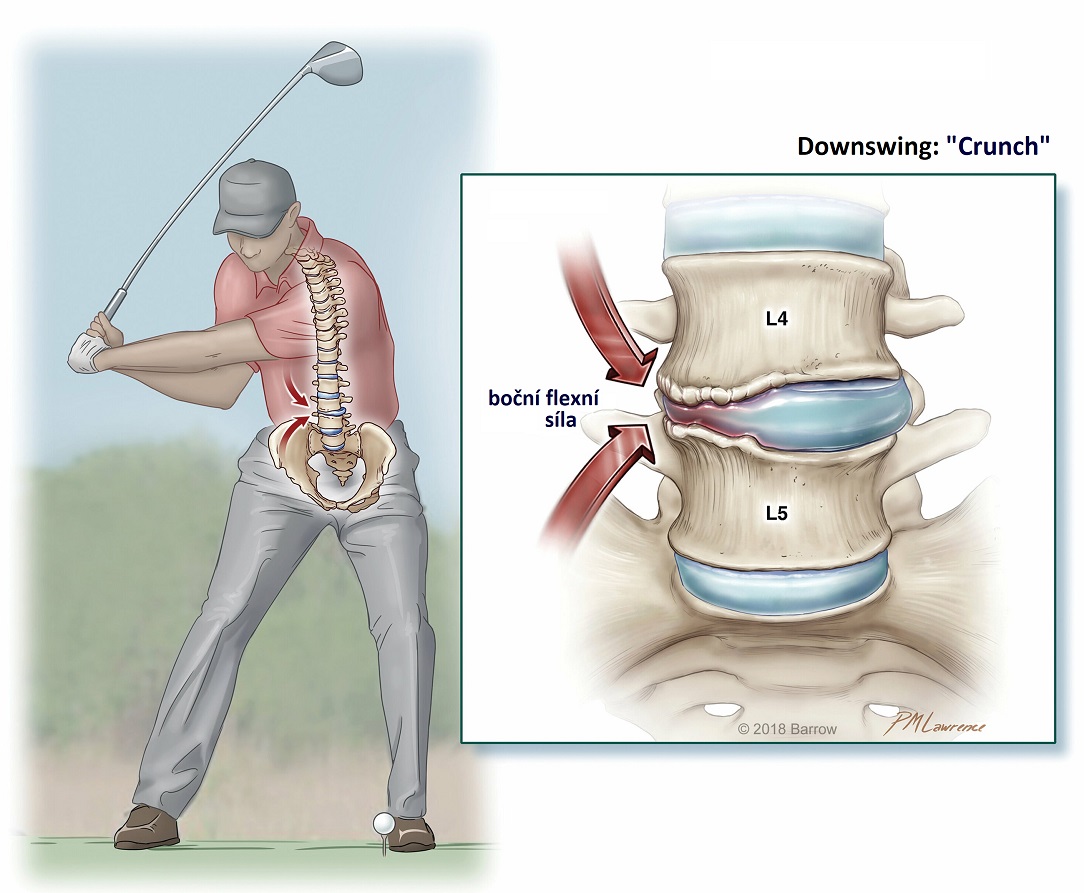 golf_lumbar_degenerationBottomCZ1084x893