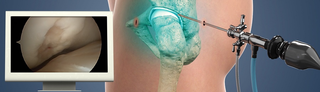 hip_arthroscopy1084x313