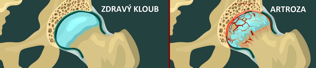 hip_osteoartritisCZ_1084X234