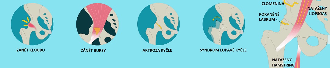 hip_pain-1084X224