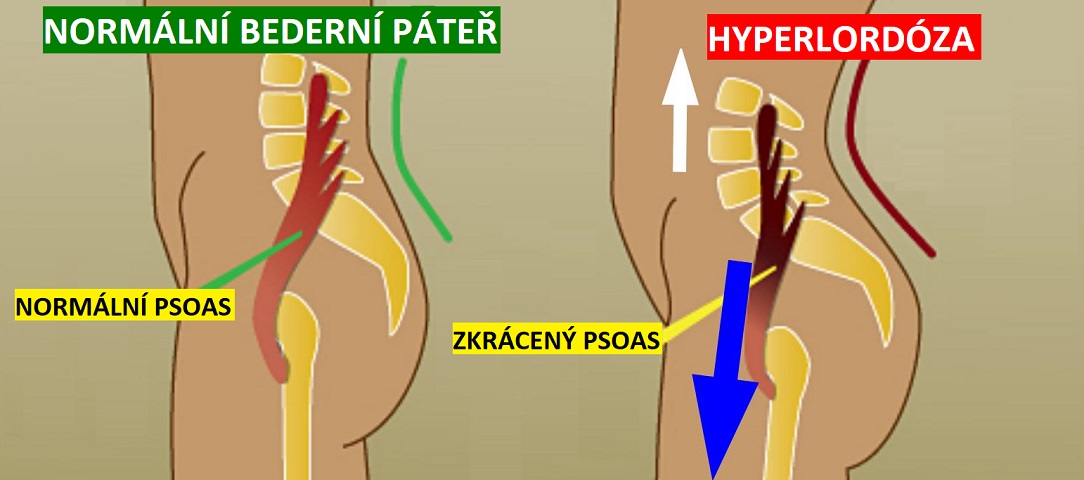 psoas_shortened_hyperlordosisCZ1084x480