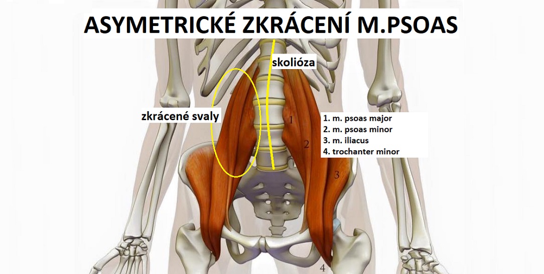 psoas_shortened_scoliosisCZ1084x547