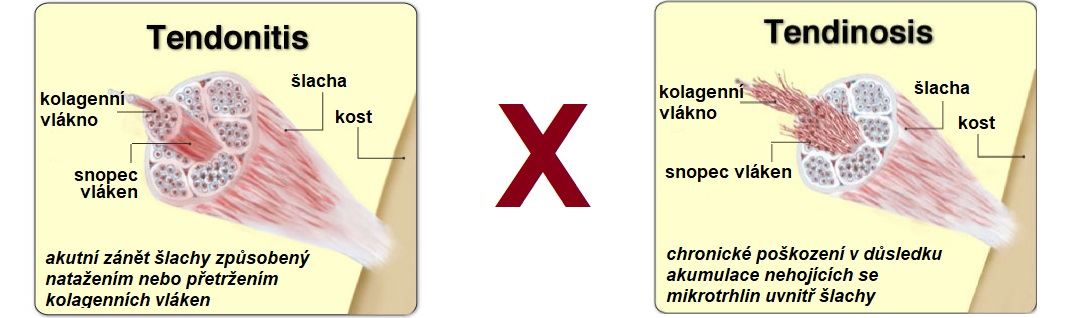 tendonitis_vs_tendinosis1084x318
